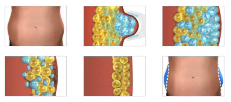 Soins du corps amincissants cryolipolyse Espace 7