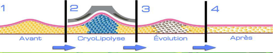 Soins du corps amincissants cryolipolyse Espace 7